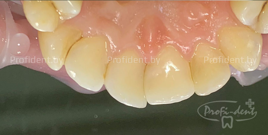 Замена дефектной пломбы в зубе 11