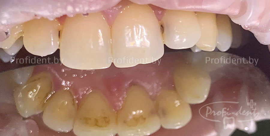 Лечение кариеса зубов 21 и 22