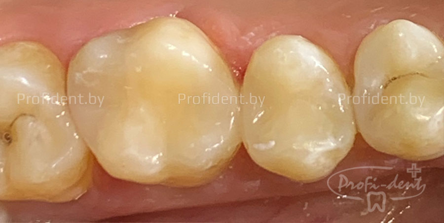 Лечение кариеса зубов 15 и 16