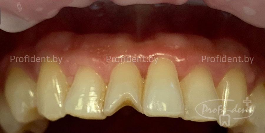 Лечение кариеса зуба 21