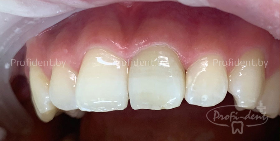 Лечение кариеса зуба 21