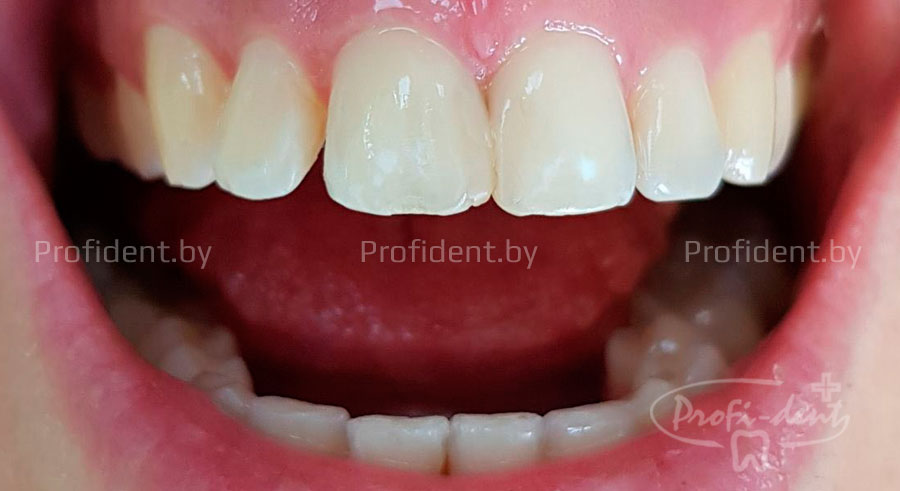 Закрытие диастемы и трем миниинвазивным вмешательством с помощью композитных материалов