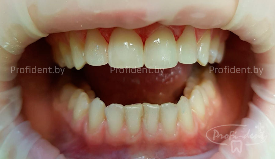 Миниинвазивные реставрации 4х фронтальных зубов