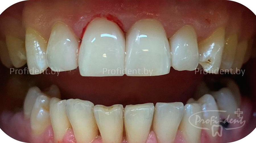 Эстетические реставрации 2х центральных резцов
