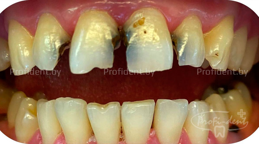 Эстетические реставрации 2х центральных резцов