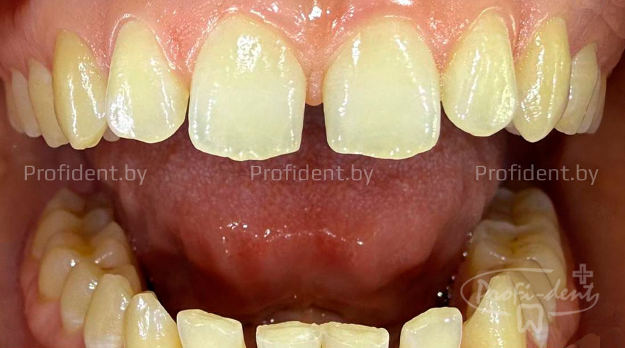 Закрытие диастемы зубов с помощью эстетической реставрации
