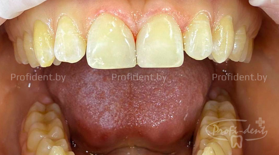 Закрытие диастемы зубов с помощью эстетической реставрации