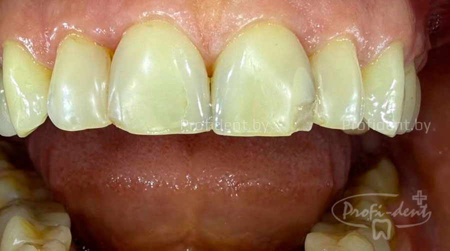 Эстетической реставрация зуба  2.1 после травмы