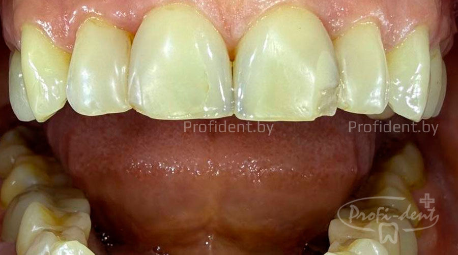Эстетической реставрация зуба  2.1 после травмы