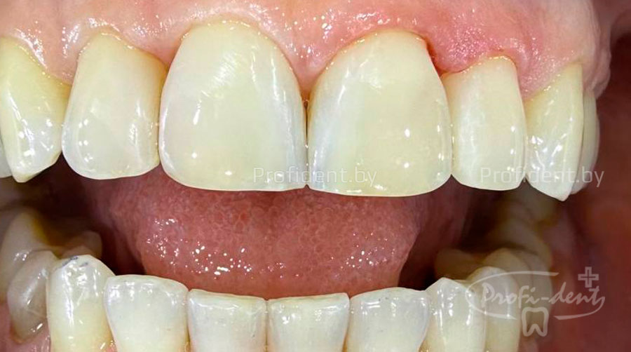 Исправление сколов на передних зубах 