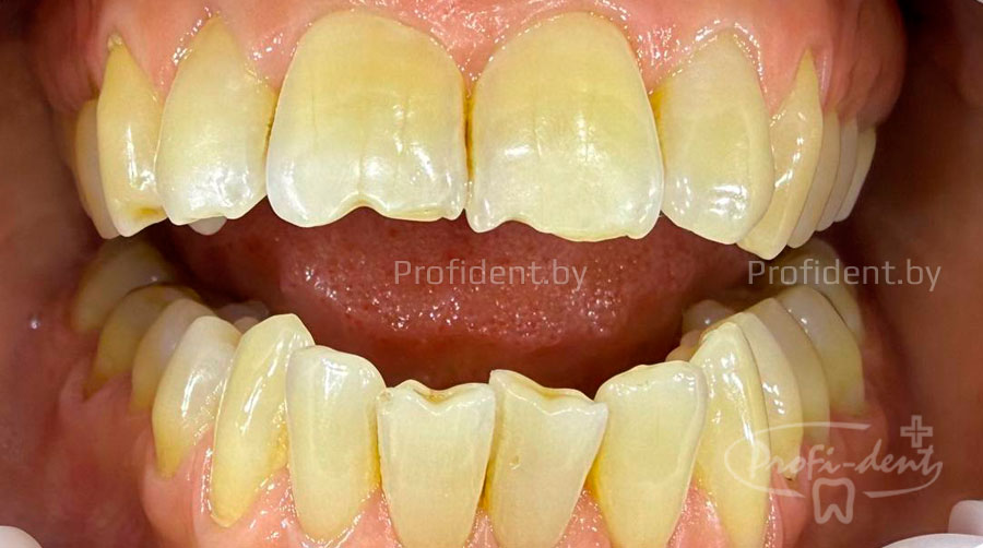 Исправление сколов на передних зубах 